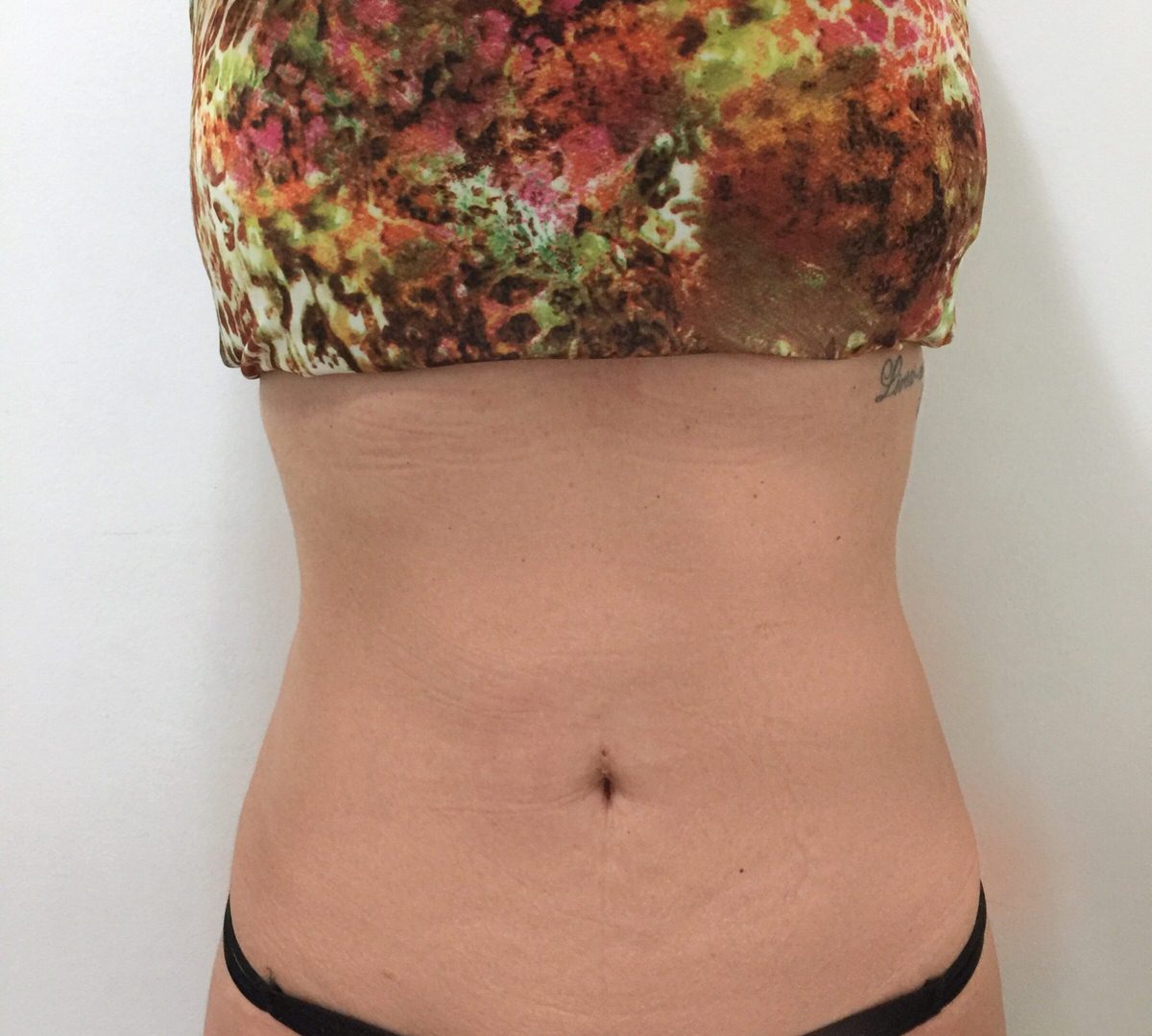 Antes e Depois resultado das sessões de drenagem modeladora na Siluets Vila Madalena